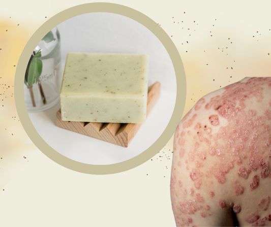 Find natural skincare solutions for eczema and psoriasis. Learn how natural soaps can soothe and improve your skin. #NaturalSoaps #Skincare #EczemaTreatment