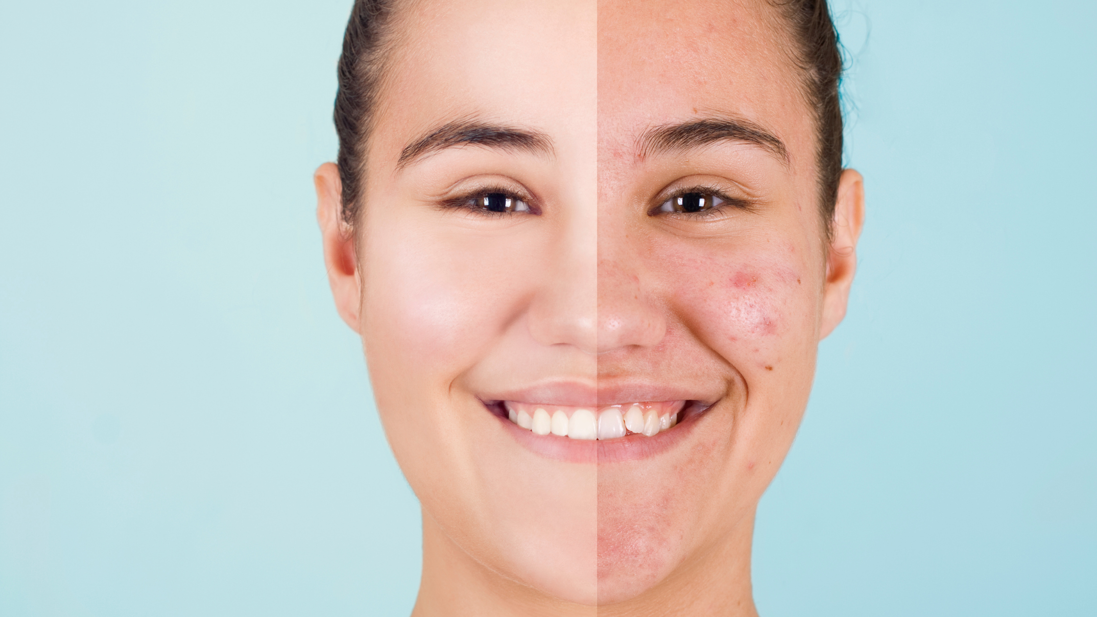Sea Moss for Acne: Reducing Breakouts Naturally – Sea Moss Me Shop
