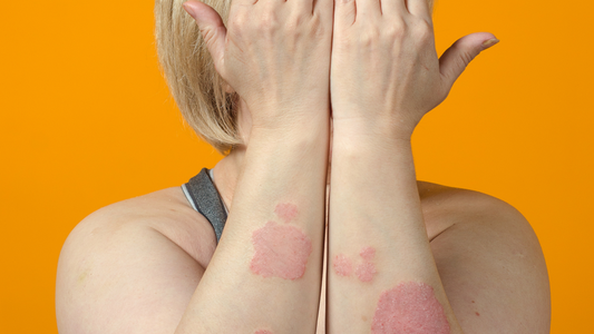 Treating Eczema and Psoriasis with Sea Moss Topically and Internally